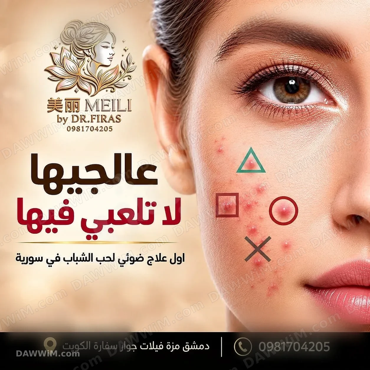 علاج حب الشباب بتقنية الضوء الديناميكي في دمشق