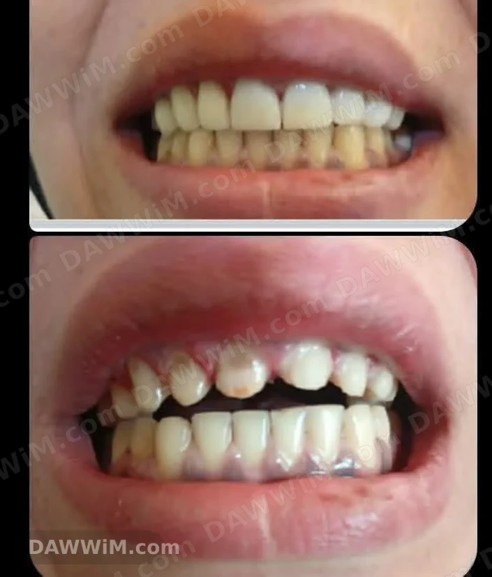 خدمة تلبيس وتجميل الأسنان وابتسامة هوليود (خدمة منزلية متاحة)