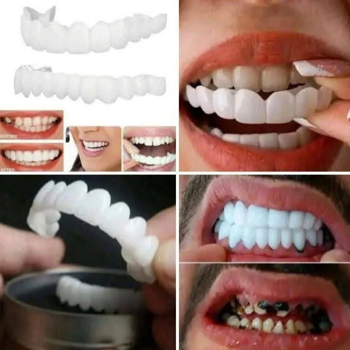 طقم أسنان فينير متحرك