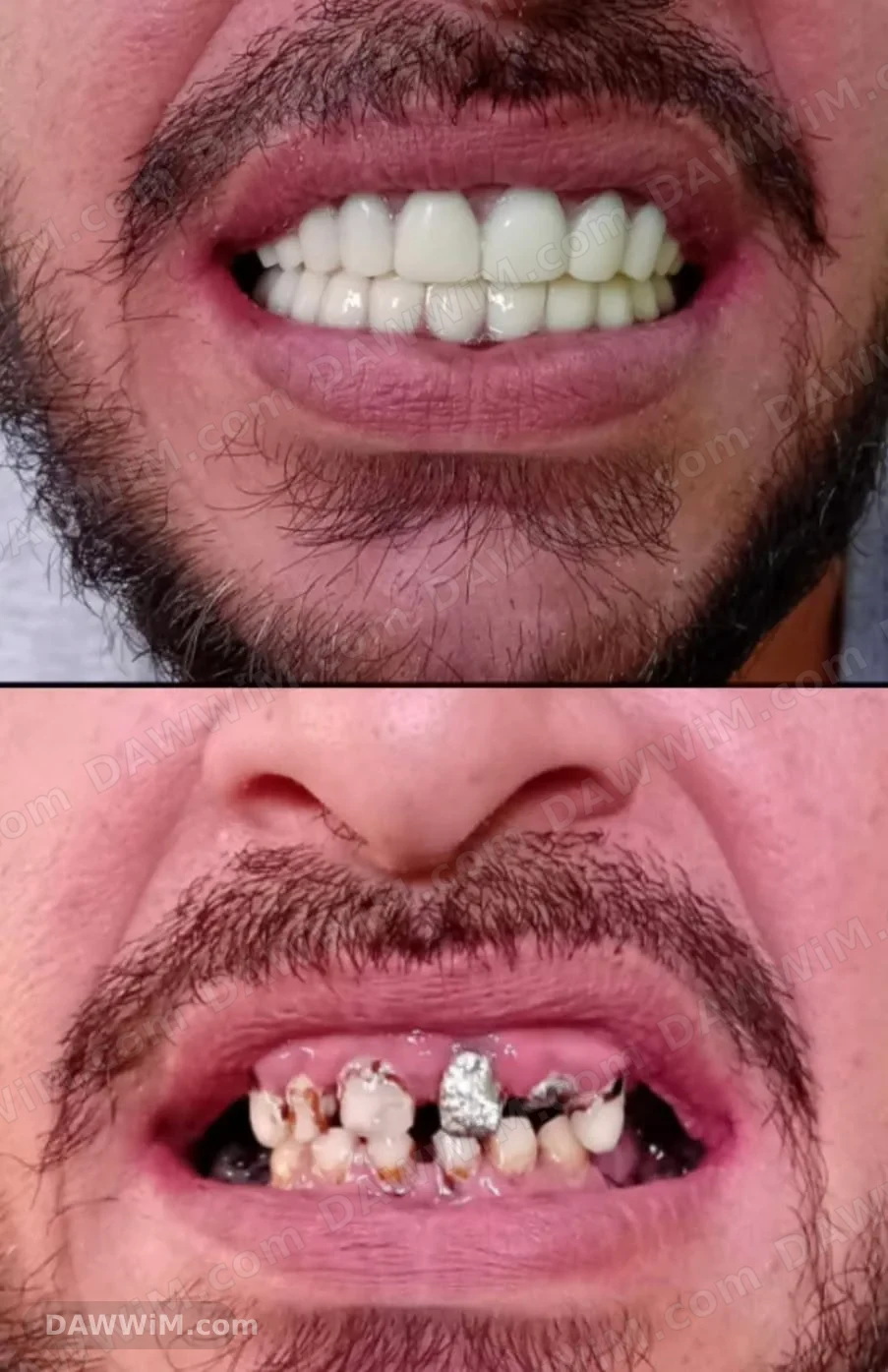 خدمات تركيب وتجميل الأسنان (ابتسامة هوليود)