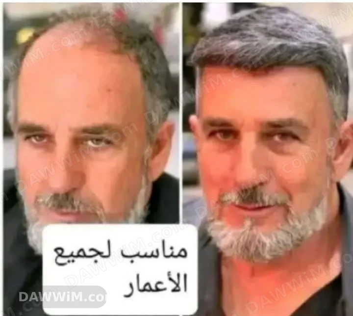 علاج لتكثيف شعر اللحية وتساقط الشعر والصلع المبكر