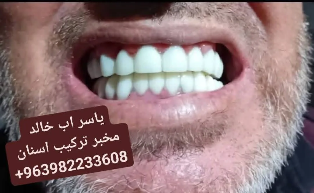 خدمة تركيب وتلبيس الأسنان مع خدمة منزلية