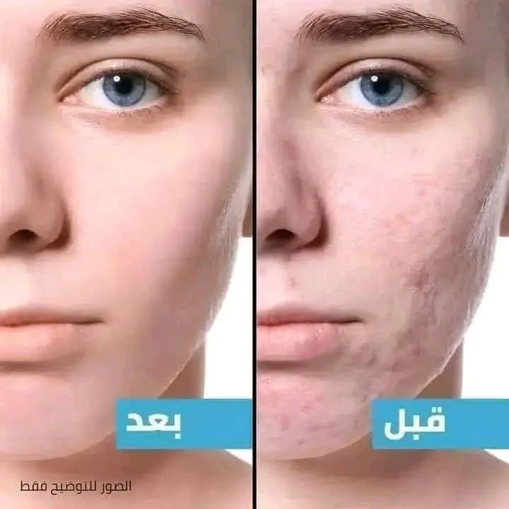 كريم ترميم البشرة فيتامين سي لإزالة الندب وآثار الجروح والحروق
