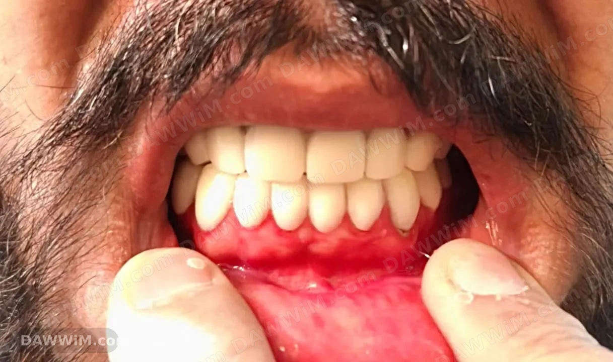 خدمة تلبيس وتجميل الأسنان بسعر لكل سن