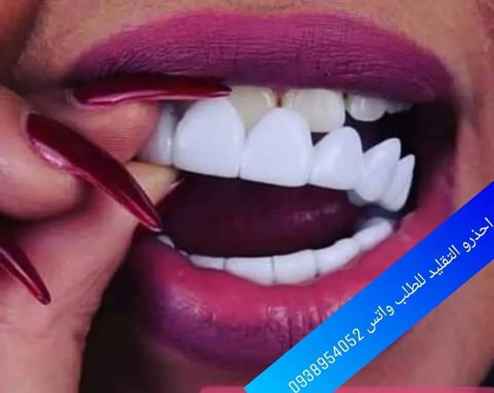 خدمة تصليح وتجميل الأسنان بطبعة حسب الطلب