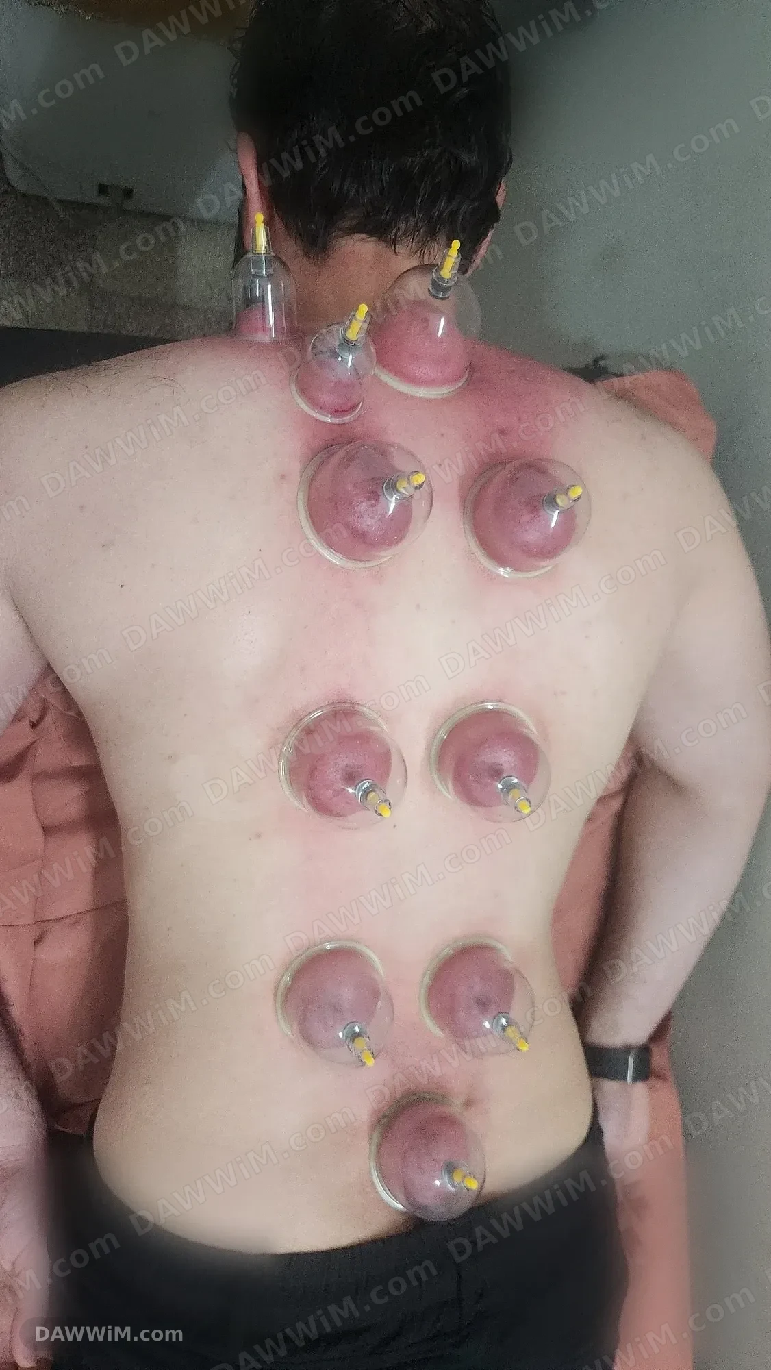 خدمة استشفاء وريكفري منزلية (حجامة - مساج - إبر صينية)