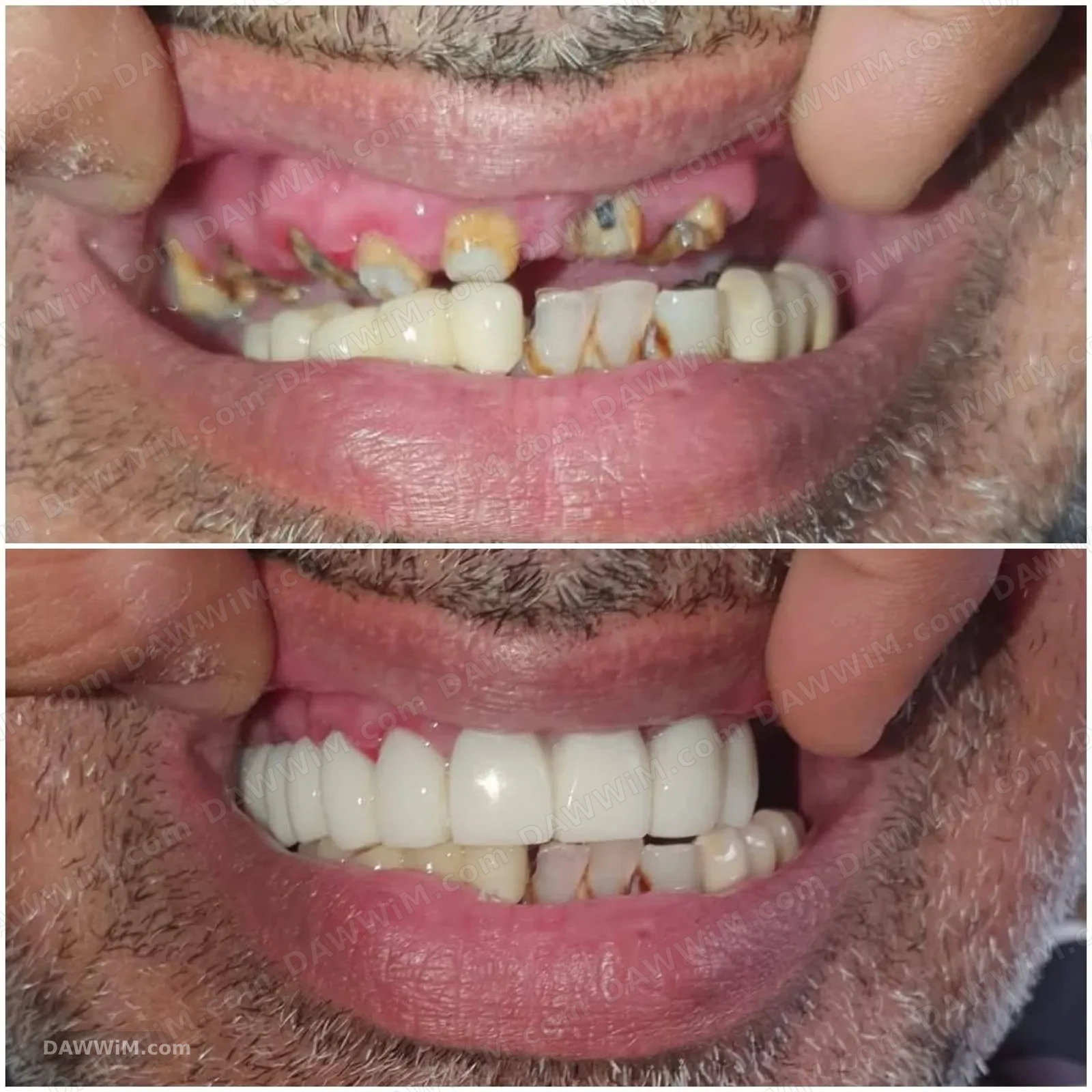 خدمة تركيب أسنان ثابتة