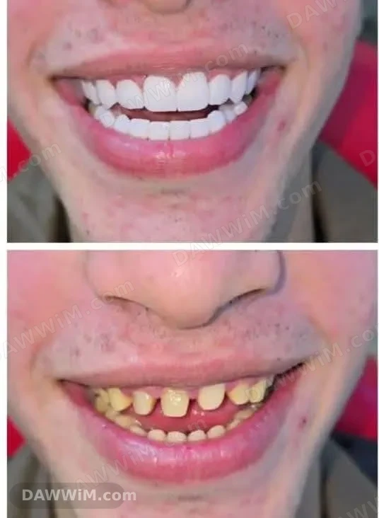 عرض تجميل الأسنان وابتسامة هوليود