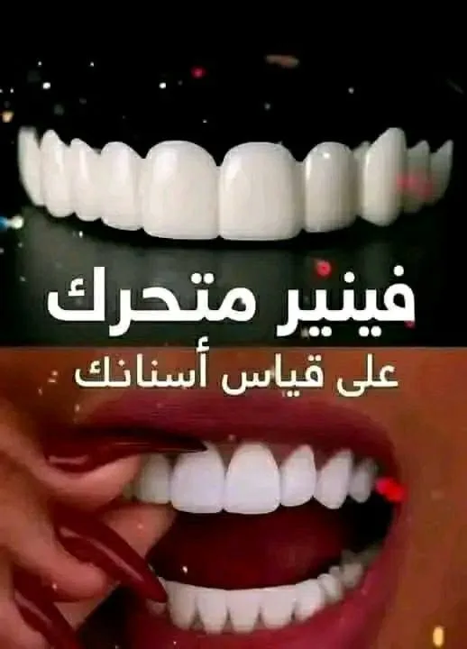 فينير متحرك للأسنان - ابتسامة هوليود متحركة