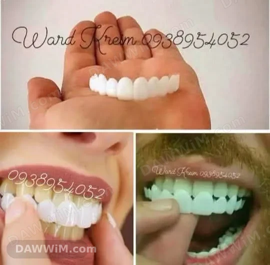 طقم أسنان فينير متحرك (Snap-on Smile)