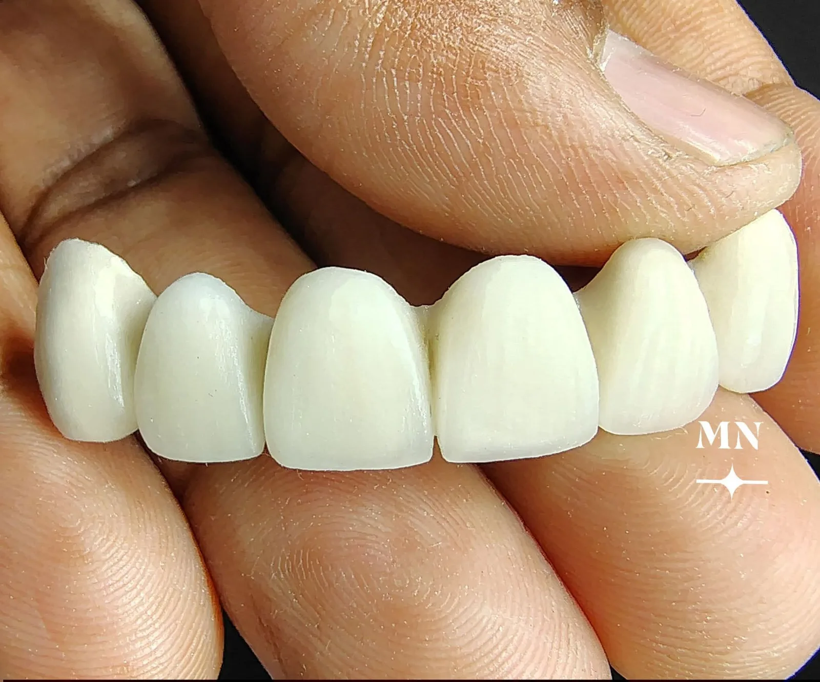 خدمة تلبيس وتجميل الأسنان مع خدمة منزلية